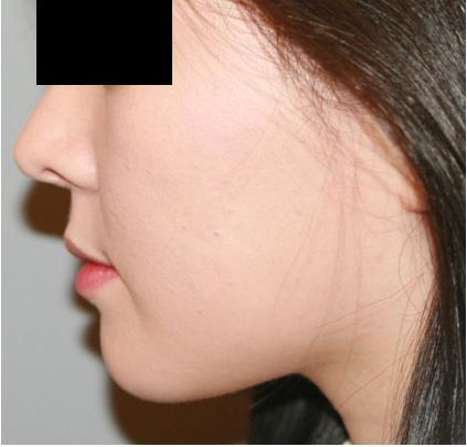 울트라V라인2.JPG