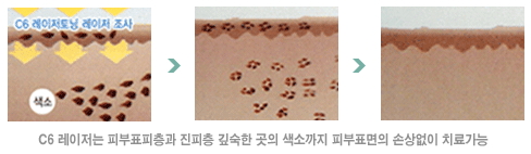 C6레이저_메카니즘.jpg