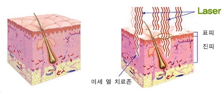 셀라스 레이저 원리.jpg
