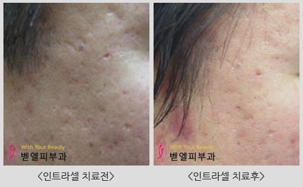 인트라셀치료전후_벧엘피부과.jpg