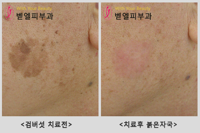 검버섯치료전_후붉은자국.jpg