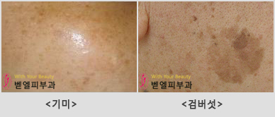 기미잡티검버섯비교.jpg