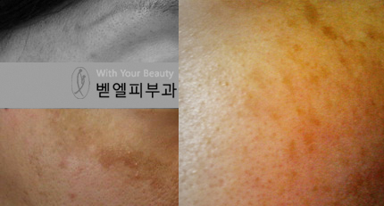 기미_잡티.jpg