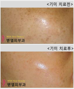 기미치료전후.jpg