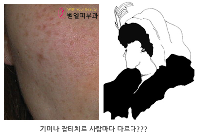 기미_잡티_만족도1.jpg