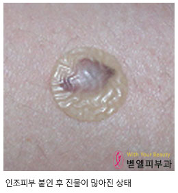 인조피부.jpg