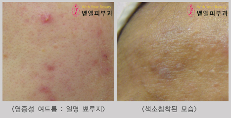 뾰루지.jpg