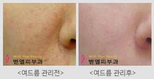 여드름트러블관리전후.jpg