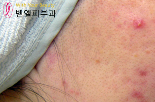 뾰루지1.jpg