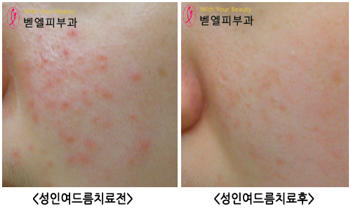 성인여드름_치료전후.jpg