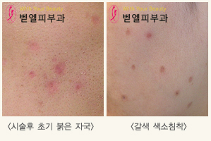 점빼기.jpg