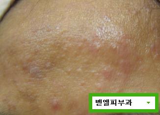 벧엘피부과_여드름자국.JPG