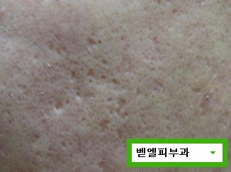 벧엘피부과_여드름흉터.JPG