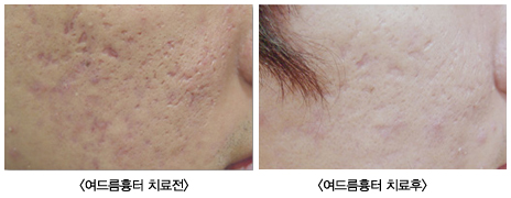 여드름흉터제거_전후.jpg