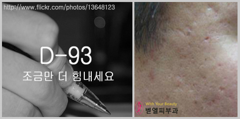 여드름_여드름흉터_수험생.jpg