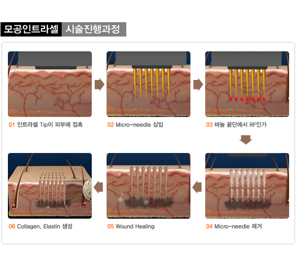 모공인트라셀_03.jpg