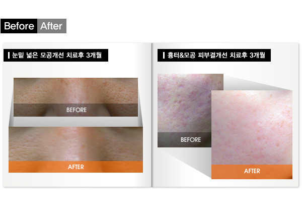 모공인트라셀_04.jpg