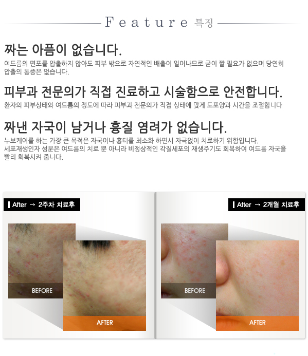 짜지않는여드름치료_엘케어_03.jpg